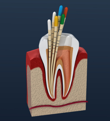 Endodontia - Desvitalização